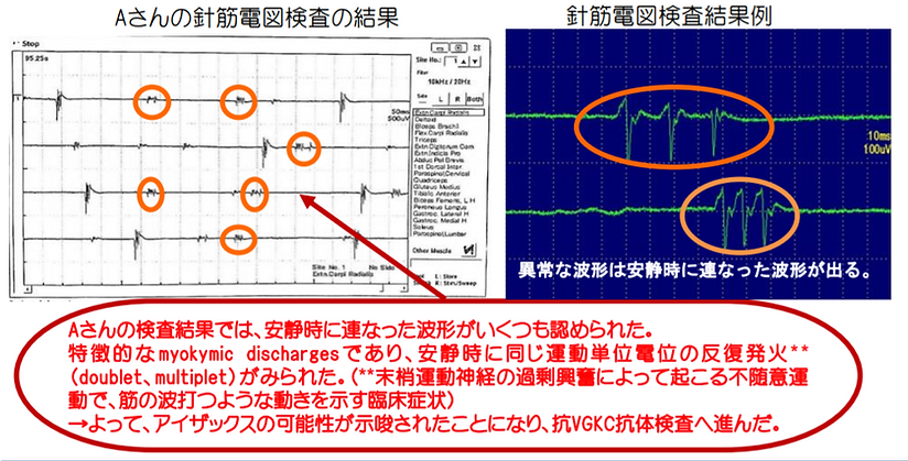 針筋電図検査の結果