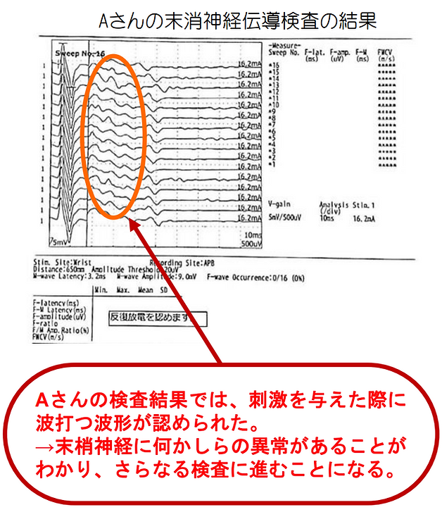 末梢神経伝導検査の結果